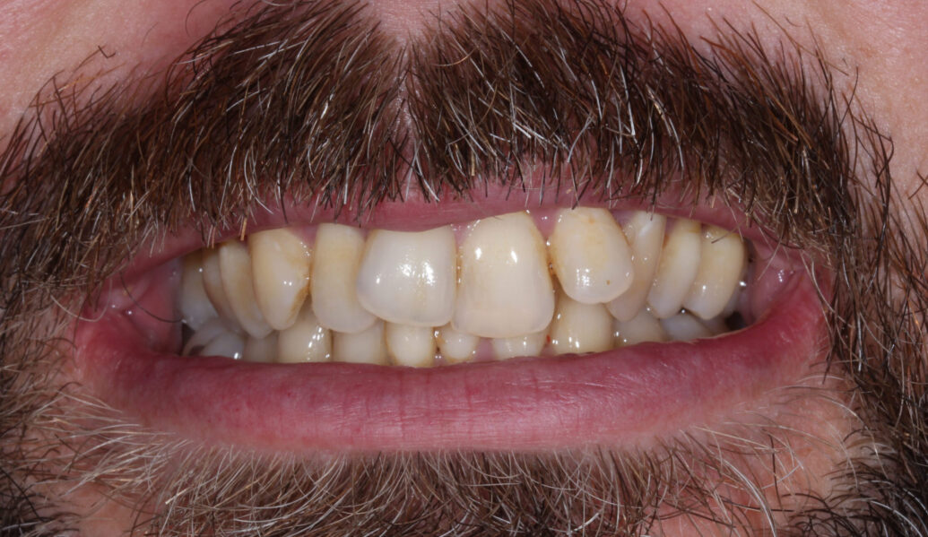 Before - Knighton Dental