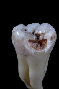 dental cavity