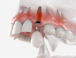 dental implant