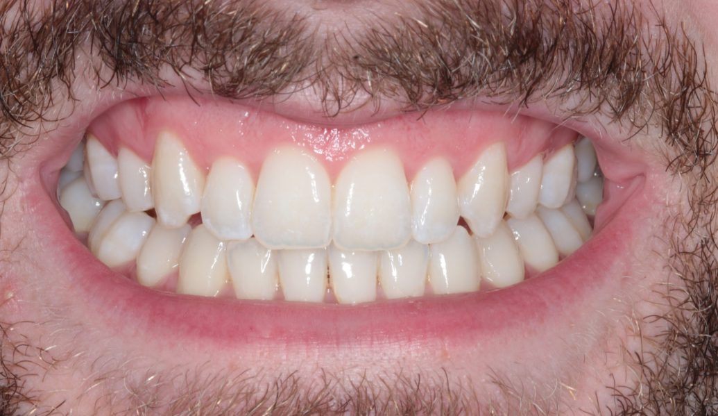 Invisalign After