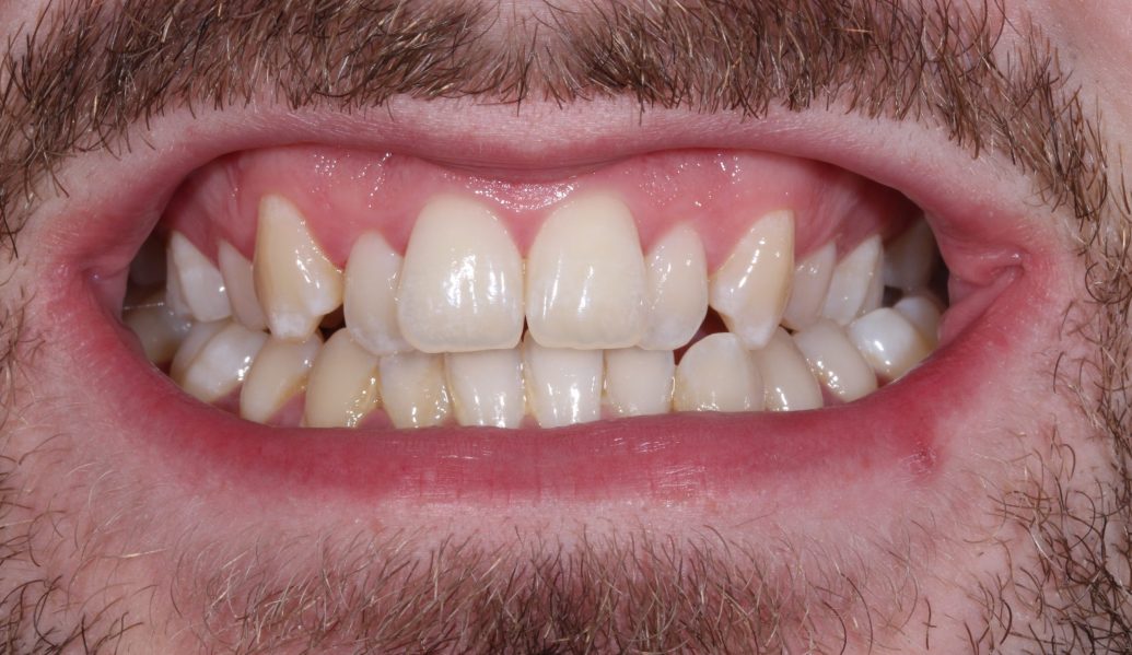 Invisalign Before