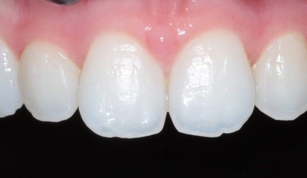 Composite Bonding Before