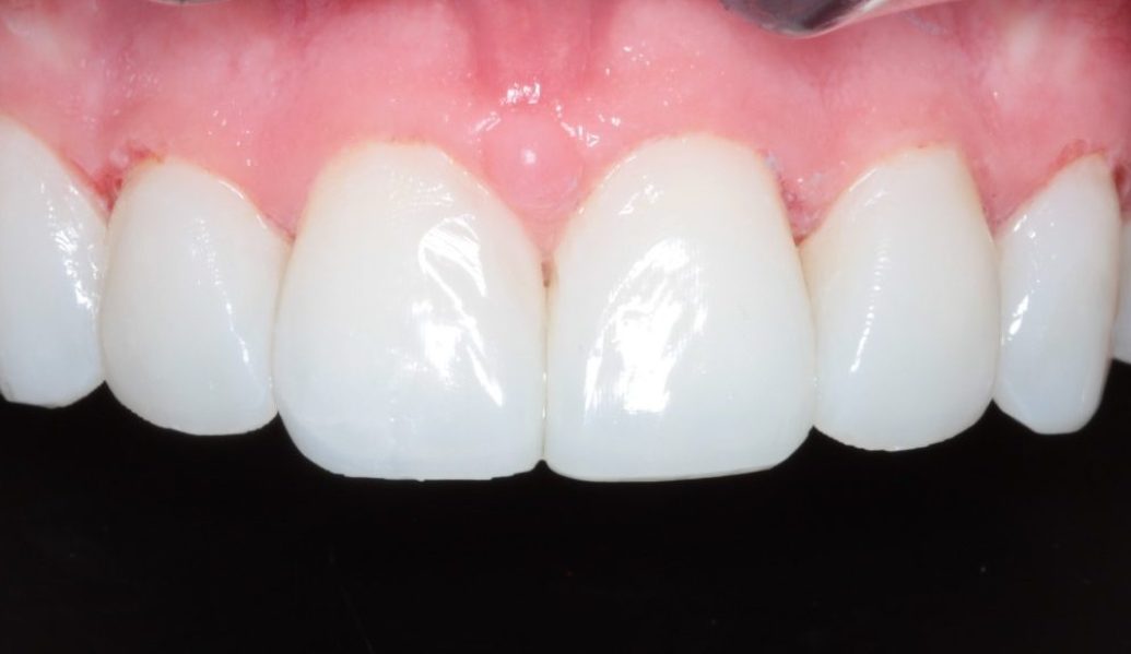Composite Bonding