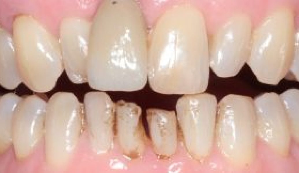Before - Knighton Dental