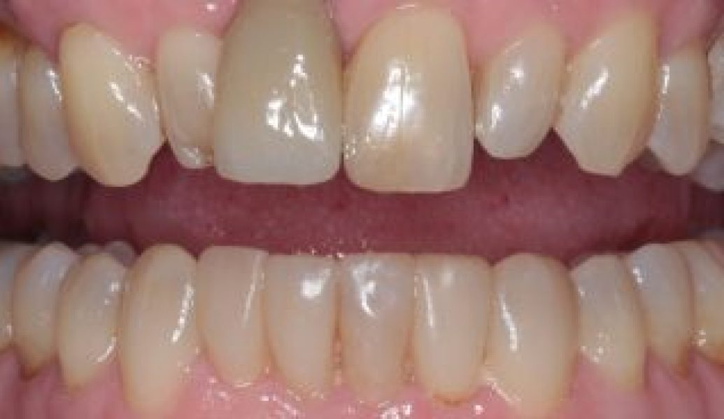 After - Knighton Dental