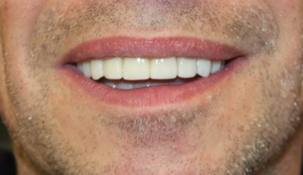 After - Knighton Dental