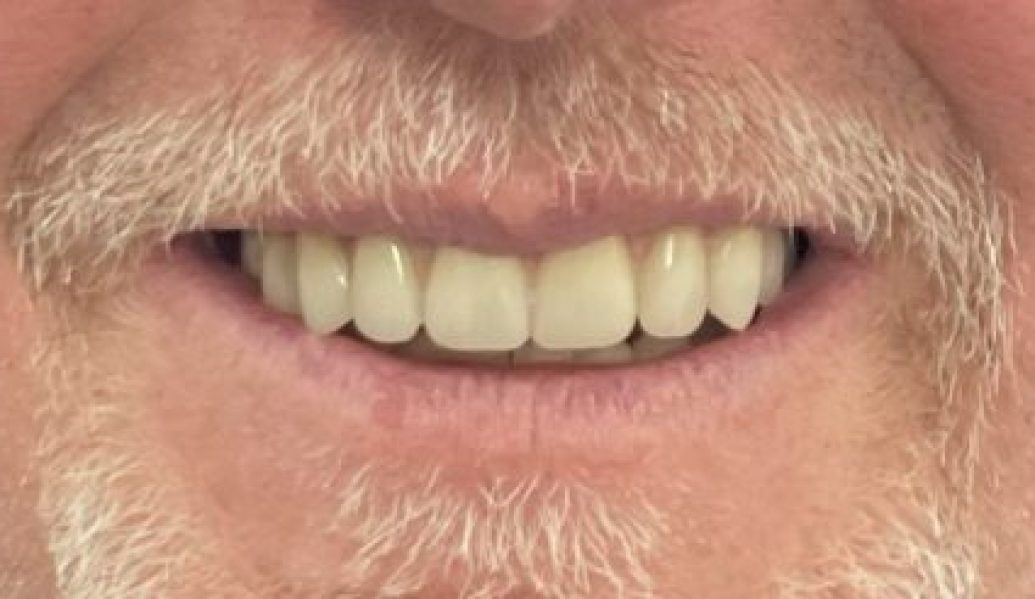 After - Knighton Dental