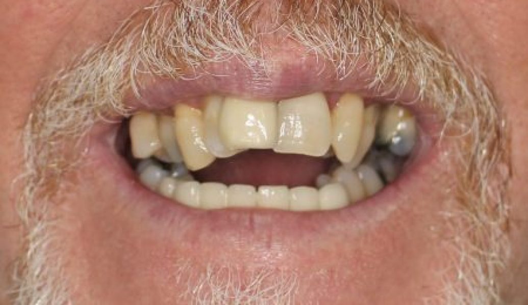 Before - Knighton Dental