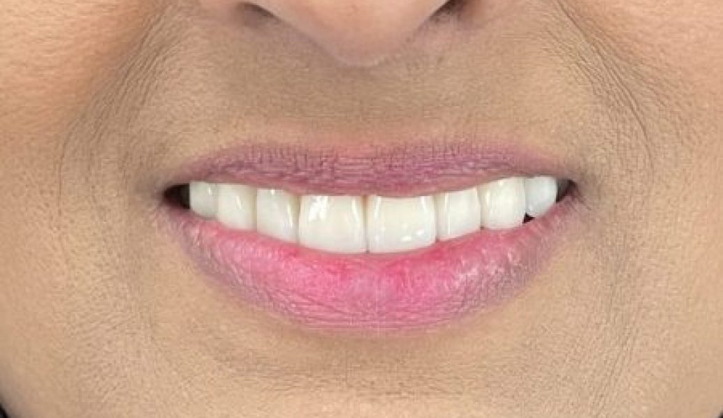 After - Knighton Dental
