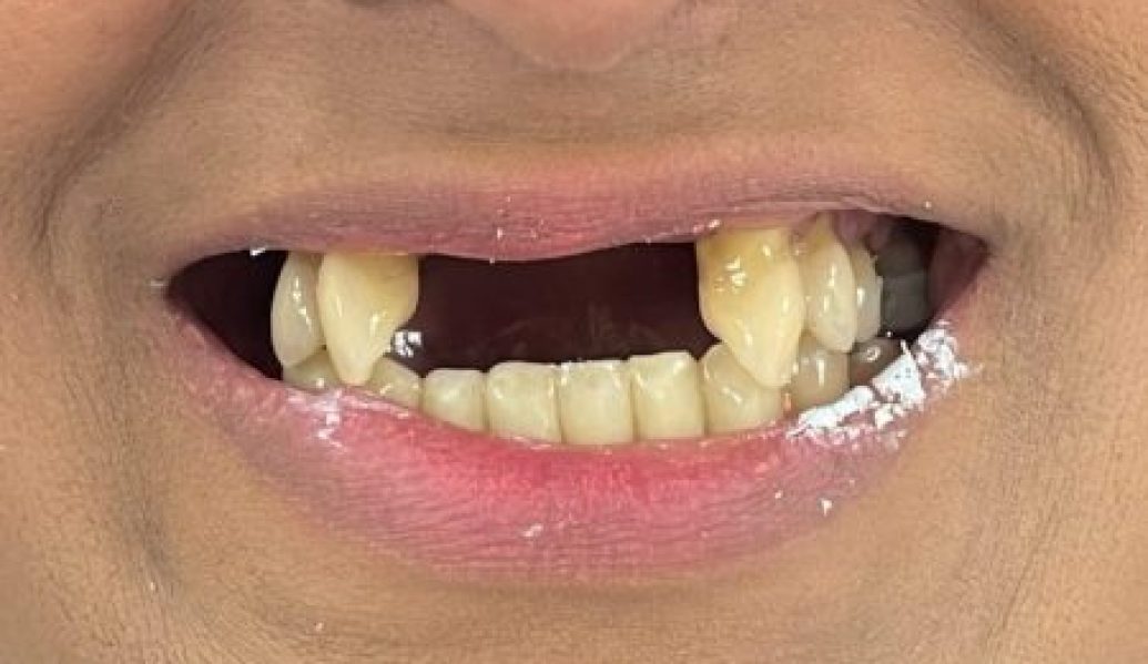 Before - Knighton Dental