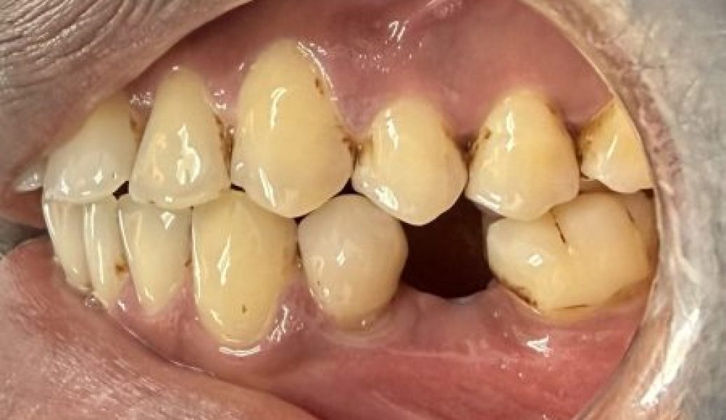 Before - Knighton Dental