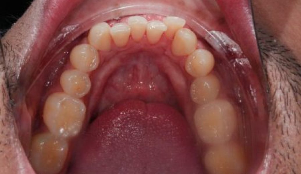Invisalign After